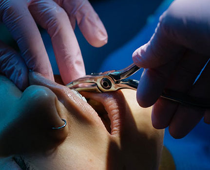 Wisdom Teeth | Ghobadi Oral & Maxillofacial Surgery