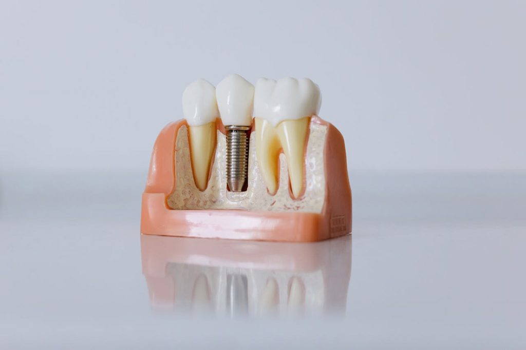 Dental Implant | Ghobadi Oral & Maxillofacial Surgery